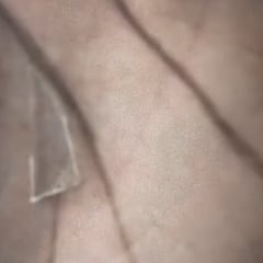 Iñaki Williams ha jugado dos años con un cristal de 2 centímetros en la planta de un pie