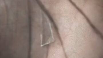 I?aki Williams ha jugado dos a?os con un cristal de 2 cent¨ªmetros en la planta de un pie