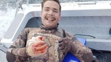 El buzo neozelandés tras el ataque de tiburón, mostrando su mano ensangrentada y levantando el pulgar de la otra en señal de que todo está bien.