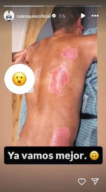 Nairo muestra las heridas que le impidieron correr La Vuelta 