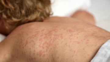 México acumula 7 mil 909 casos de sarampión en las 32 entidades del país. El Gobierno hace un llamado a vacunarse contra esta enfermedad altamente contagiosa.