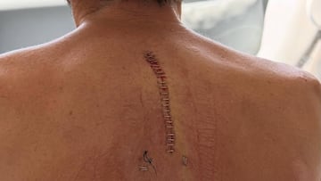 Aleix Espargaró tras ser intervenido de su fractura de vértebras.