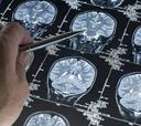 Científicos de USA encuentran una forma de detección temprana del Alzheimer