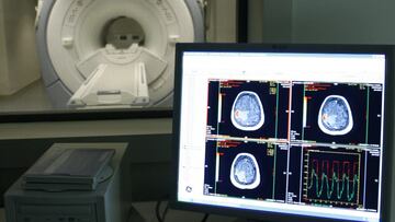 Los ‘guardianes’ del cerebro dejan al descubierto al alzhéimer