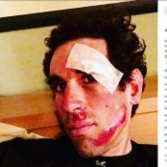 Así quedó la cara de Alberto Losada tras su caída