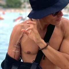 Márquez muestra su impactante cicatriz