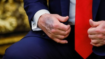 The mystery behind Donald Trump’s hand bruises explained