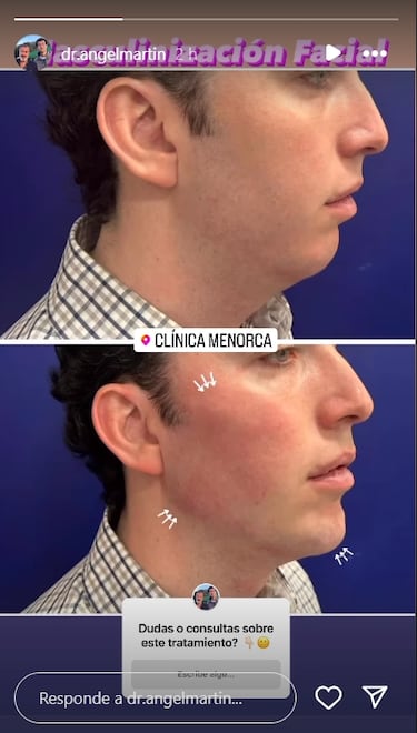 As es la masculinizacin facial: el retoque esttico del Peque?o Nicols