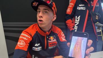 Acosta mostró la foto de su brazo operado de síndrome compartimental.