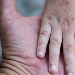 Brote de sarampión en Texas: ¿es necesario vacunarse de nuevo? Esto dicen los expertos