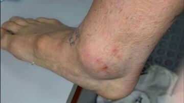 'Papu' Gómez muestra su tobillo en redes tras la batalla en Calama