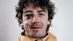 Mark McMorris con un ojo morado tras una caída practicando snowboard.