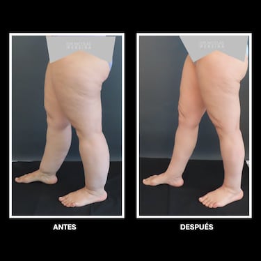 La enfermedad silenciosa que afecta a miles de mujeres en Chile: se confunde con la obesidad 