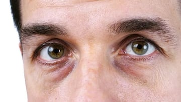 Una médico de estética explica qué es lo que dicen las ojeras sobre tu salud: mala alimentación y trastornos del metabolismo