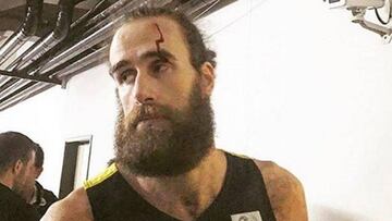 Gigi Datome, con la brecha producida por el impacto de un objeto lanzado desde la grada.