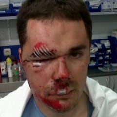 Markel Irizar muestra sus heridas de guerra