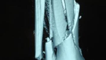 <b>DESTROZO Y RECONSTRUCCIÓN. </b>Las tres primeras radiografías muestran las fracturas de Simón; la cuarta es ya tras la operación.