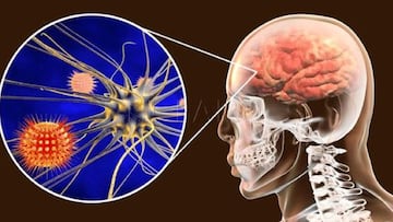 Meningitis en México: ¿cuáles son las causas principales y por qué es tan peligroso?