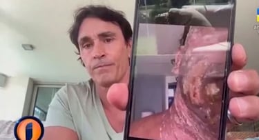 Sebastián Estevanez mostró fotos de su rostro tras el accidente con alcohol para concientizar