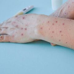 Viruela del mono en México: López-Gatell confirma segundo caso en CDMX