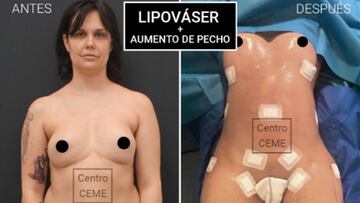 Imágenes de Miriam Sánchez antes y después de realizarse a un lipováser y a un aumento de pecho.