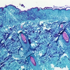 ¿Cómo se contagia la viruela del mono y cuáles son las diferencias con la COVID-19?