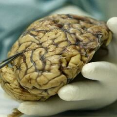 Detectan 'células zombies' en el cerebro humano tras la muerte
