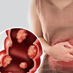 Los síntomas que pueden indicar un cáncer de colon