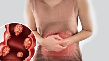 Los síntomas que pueden indicar un cáncer de colon