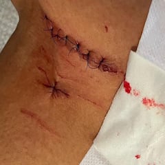 Águeda Marqués termina en Metz con puntos en la pierna