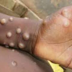 Viruela del mono: cuántos países tienen casos y qué medidas están tomando