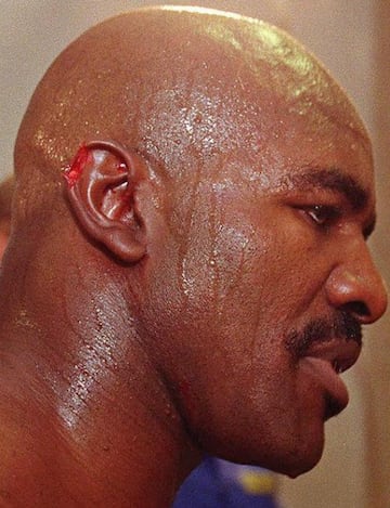 Más que por estética, el boxeador se reconstruyó la oreja por una mordida de Mike Tyson