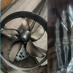 William Aliotti se rebana dos dedos con su foil eléctrico