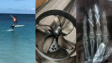 Wiliam Aliotti, accidente foil eléctrico y radiografía con los dedos rebanados.