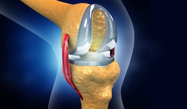 ¿Tienes dolor de rodilla y 30 años de edad?, tu cartílago se esta deteriorando por esta razón