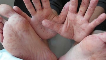 Se registran casos positivos al virus Coxasckie en el sur de México: hay alerta en menores de 1 a 9 años.