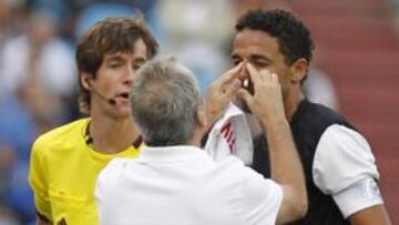 Weligton tiene fracturado el tabique pero no será operado