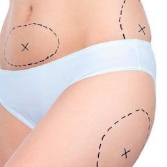 ¿Cuánto cuesta una lipoescultura, qué diferencias hay con liposucción y cuáles son los riesgos?