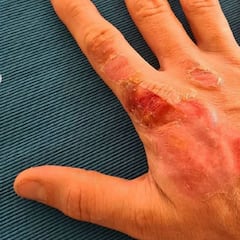 Así está la mano derecha de Grosjean tras el accidente