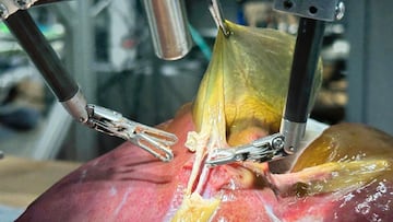 El robot quirúrgico Transformer-Hierarchy realizando una cirugía de vesícula biliar.