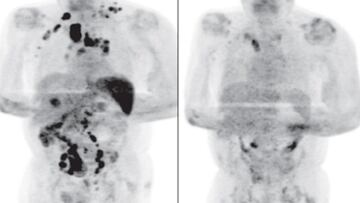 La COVID-19 desencadena una respuesta inmunitaria antitumoral en un hombre de 61 años