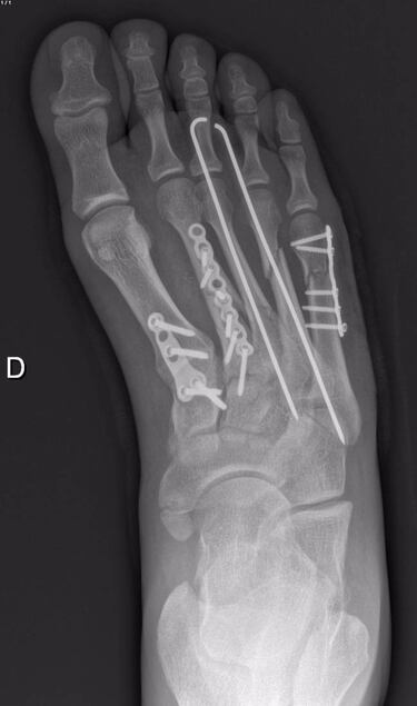 Tres placas, dos clavos y quince tornillos en el pie de Baz