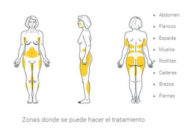 ?Cunto cuesta una lipoescultura, qu diferencias hay con liposuccin y cules son los riesgos?
