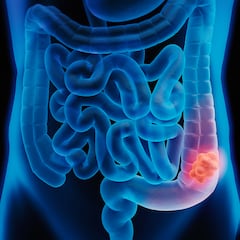 Descubren que los millenials se callan el gran síntoma detrás del cáncer de colón cuando van al médico por este motivo