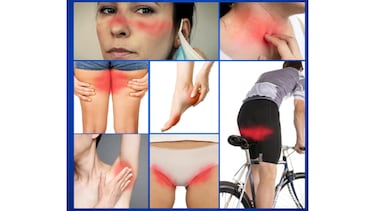 ?Cmo evitar las rozaduras en los muslos, ingles y ms al correr?