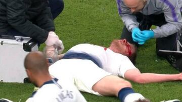 Susto de Vertonghen: se fue mareado tras un golpe en la cabeza que le hizo sangrar