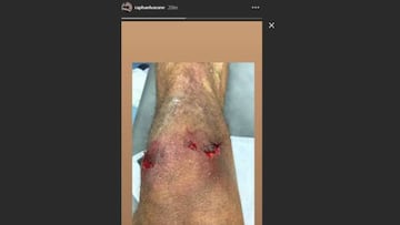 Varane subió una imagen de su rodilla izquierda a su Instagram.