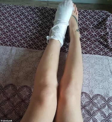 Se lanzó a un lago congelado y acabó con el tobillo fracturado