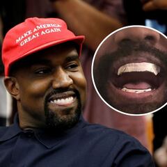 Kanye West reemplaza sus dientes con dentaduras postizas de titanio