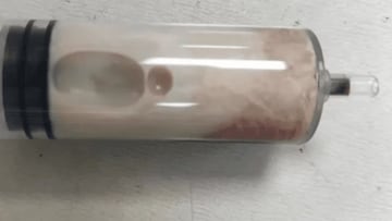 “La sangre es blanca”: sorpresa por la analítica de un paciente que cenó lo mismo durante una semana